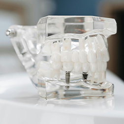 TrediDental_BlogImage_252x252_Which Dental Implant Procedure Is Right for You